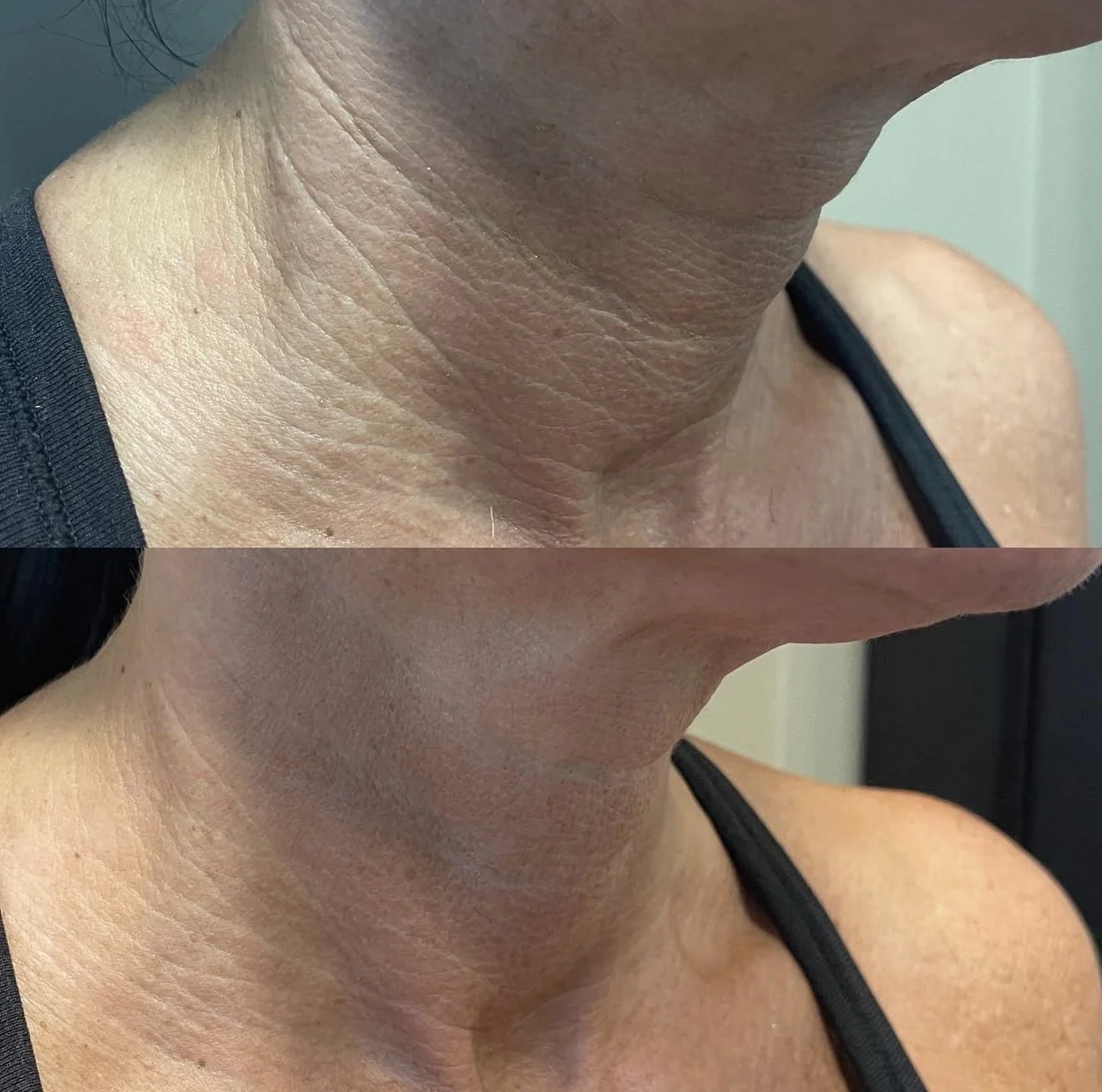 Antiwrinkle Before & After