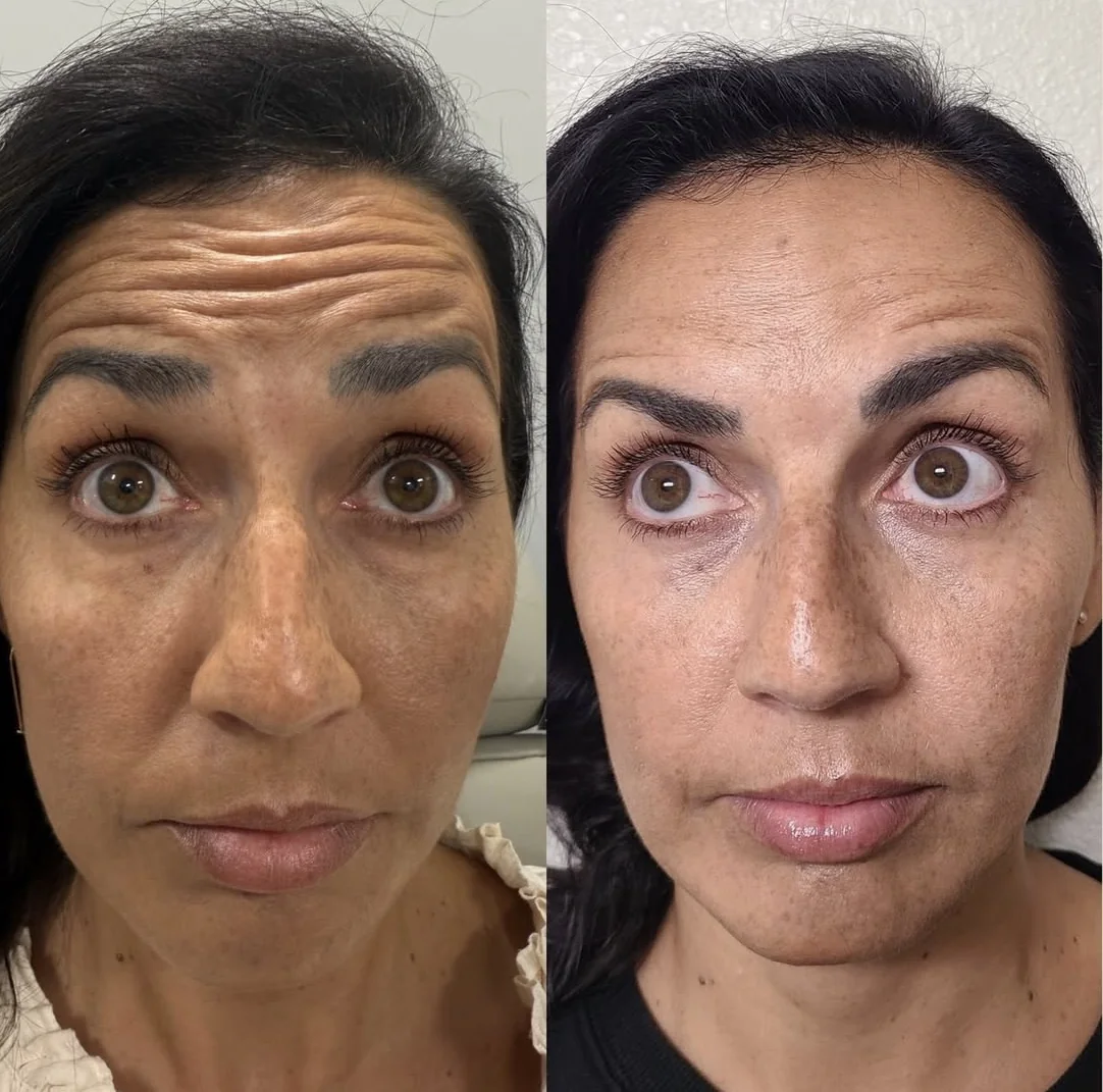 Antiwrinkle before and After
