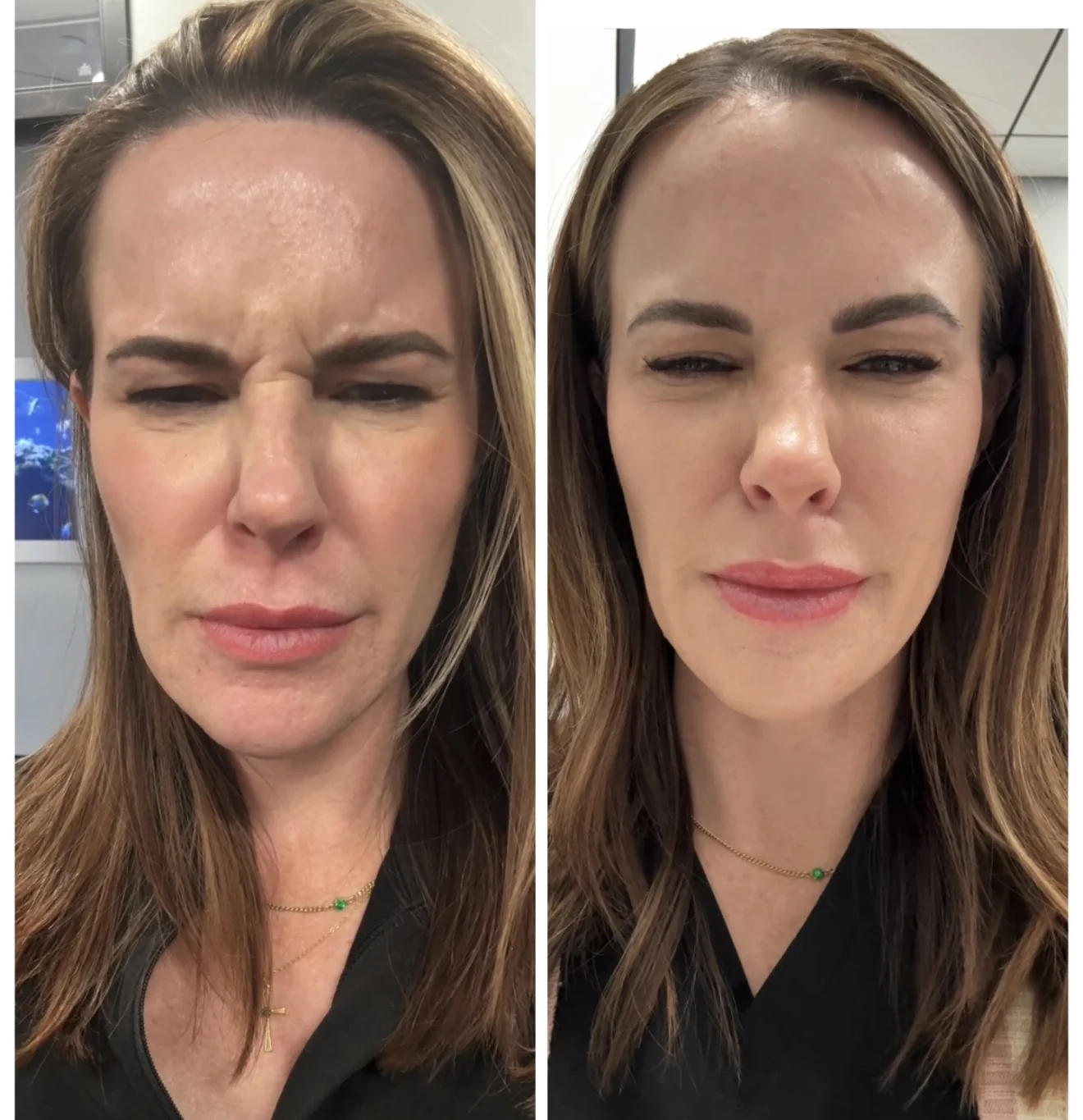 Antiwrinkle Before and After