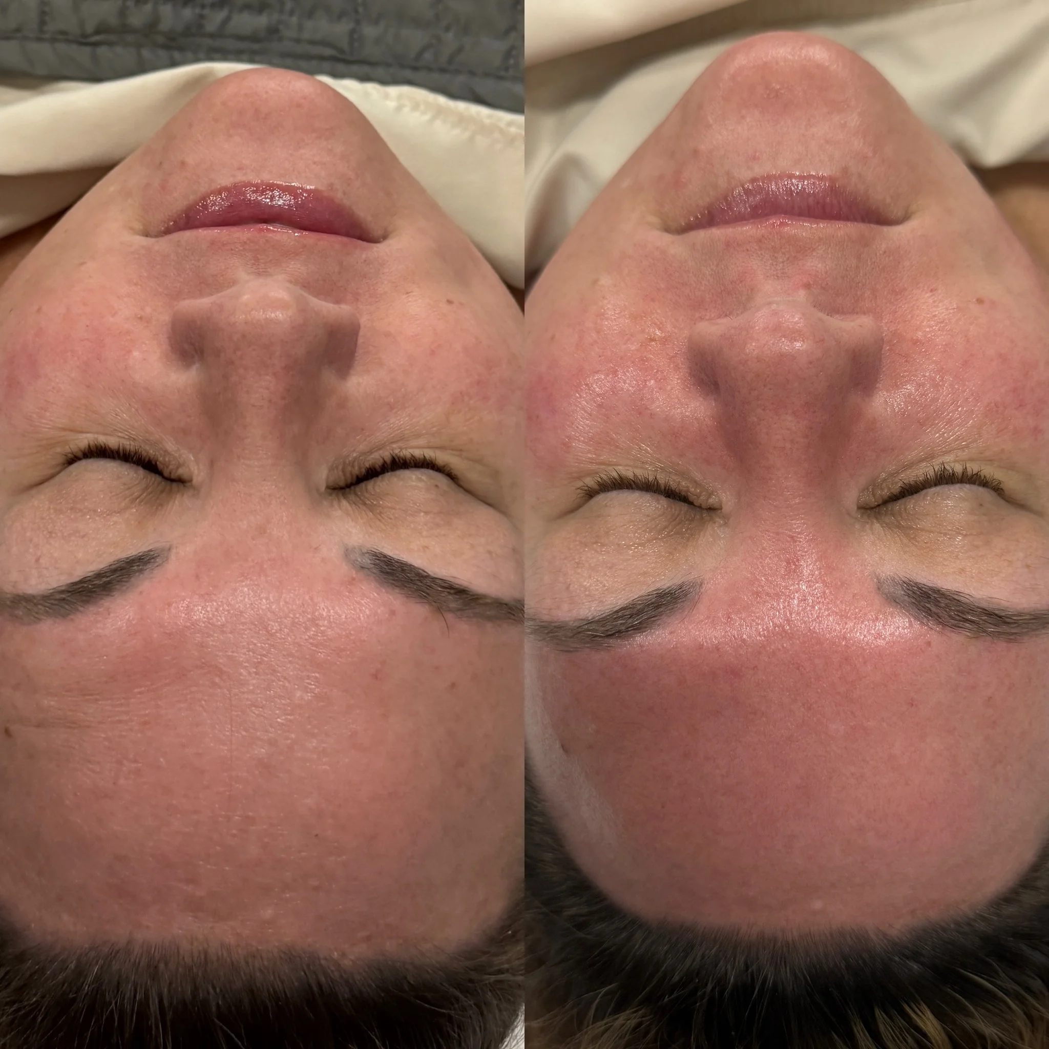 Facial Before & After