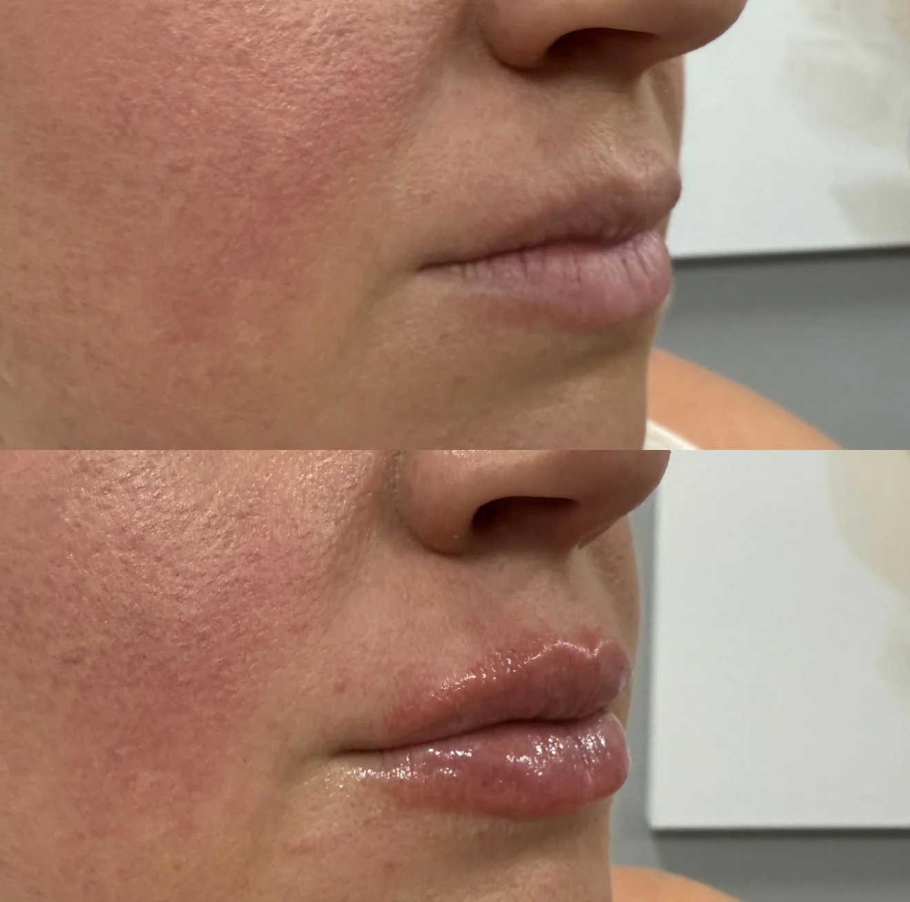 Juvederm before and After