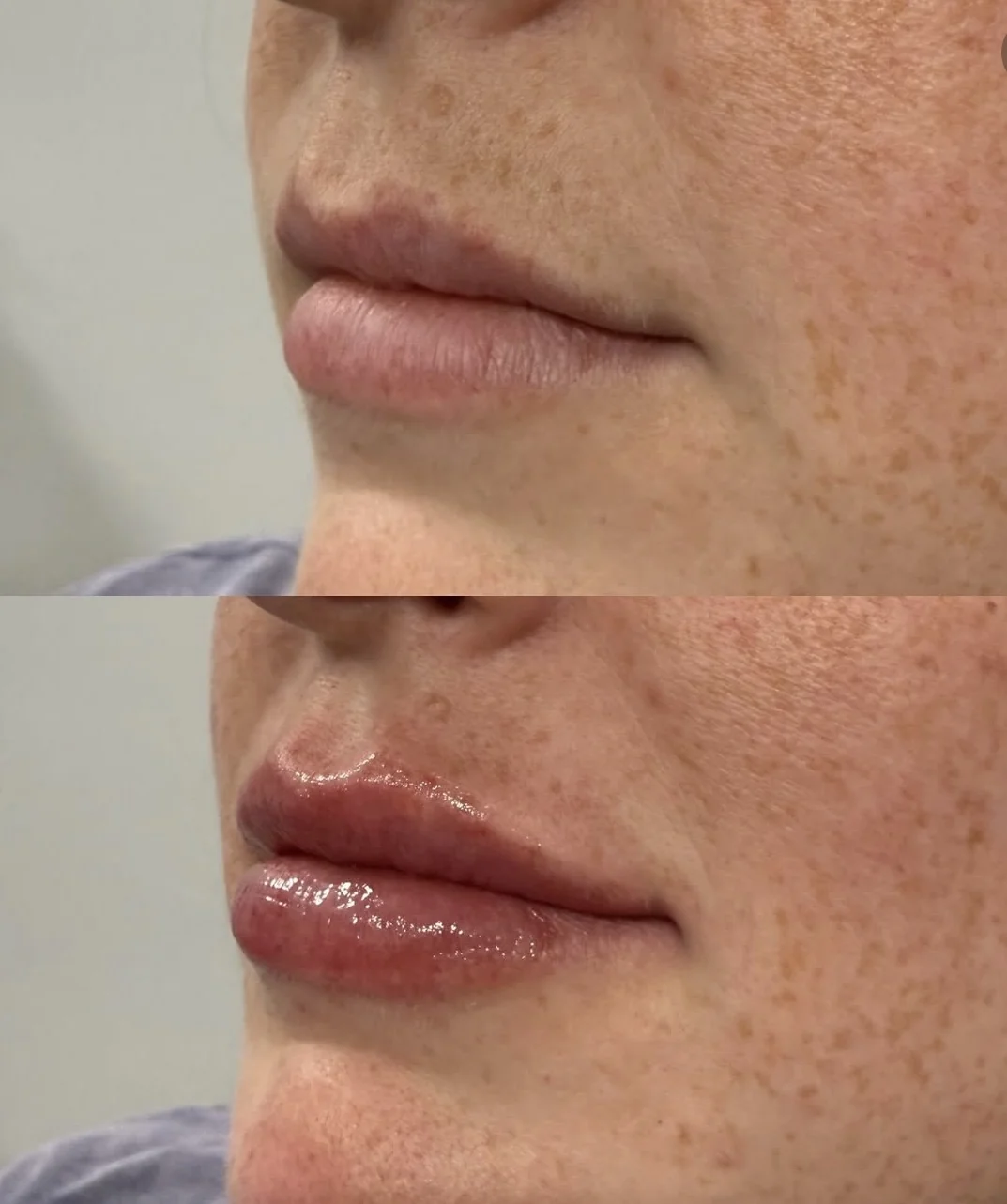 Juvederm Before and After