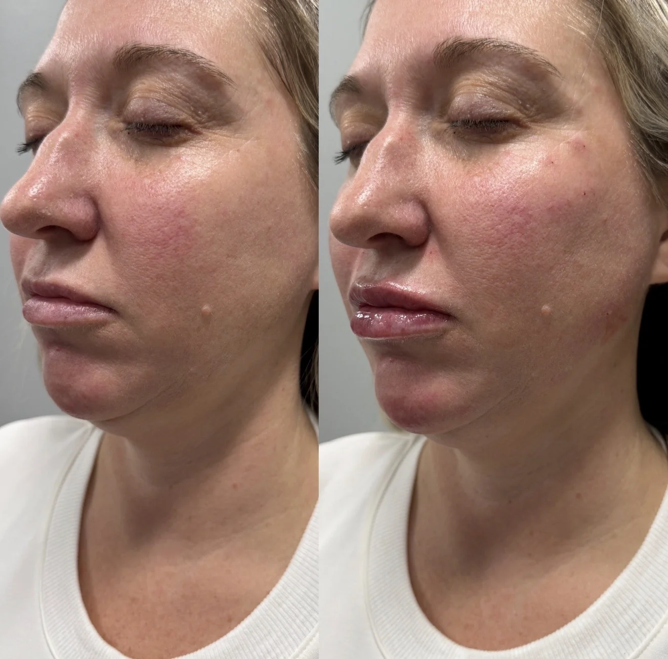 Juvederm Before & After
