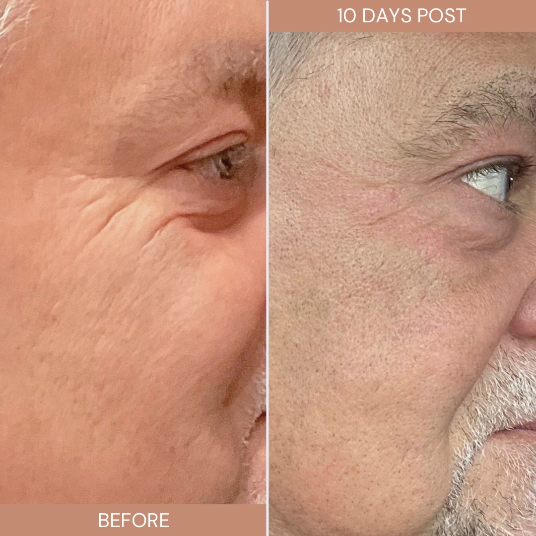 AquaFirmeXS Before & After 3