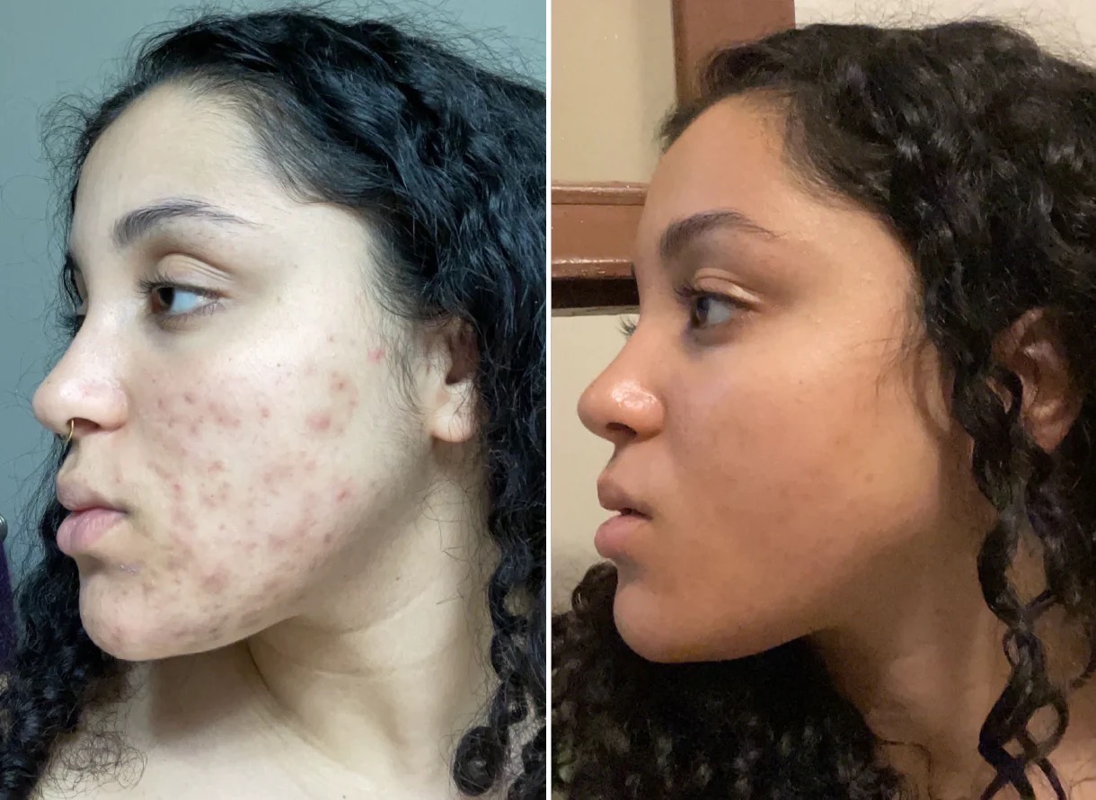 NOUVADerm Treatment 1