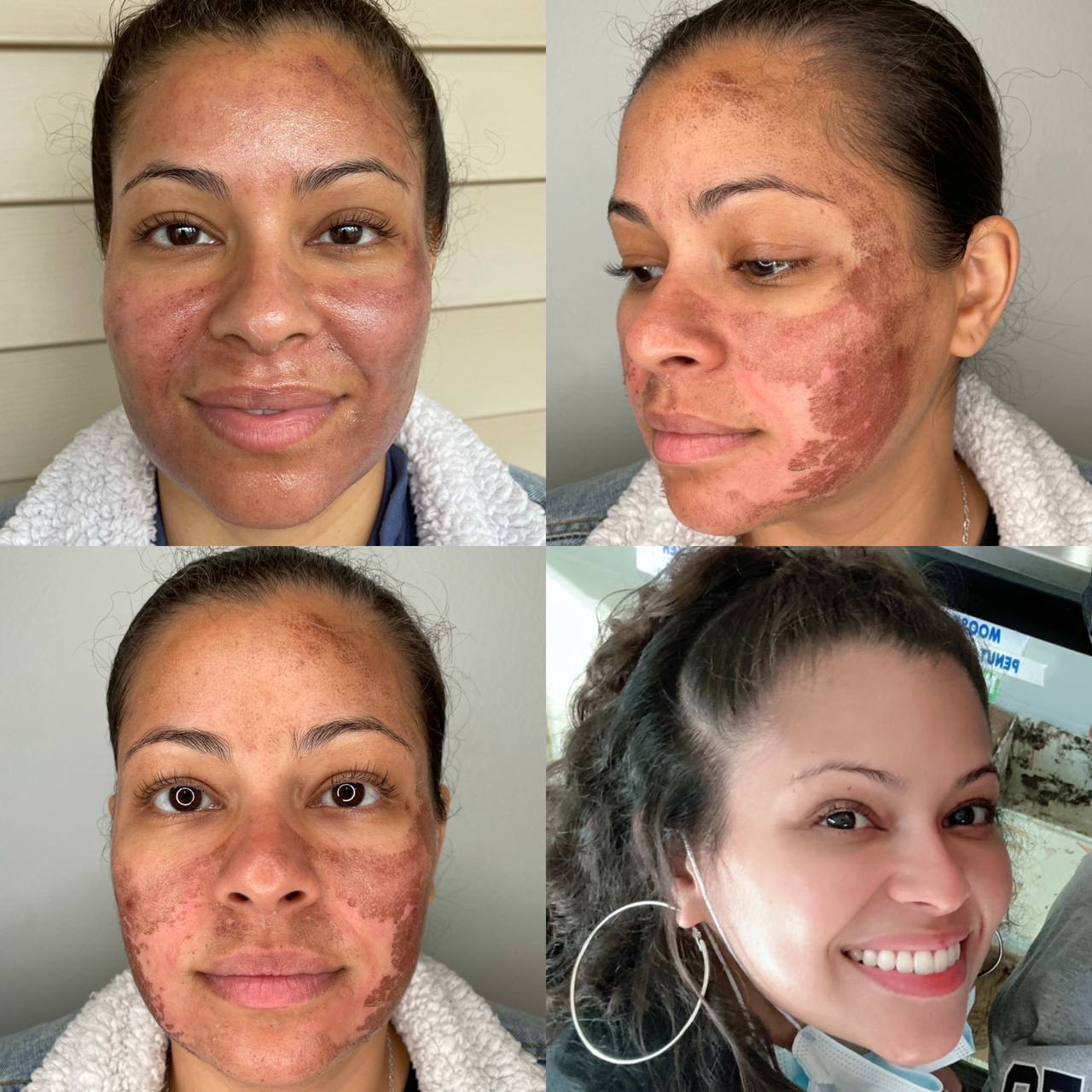 NOUVADerm Treatment 2