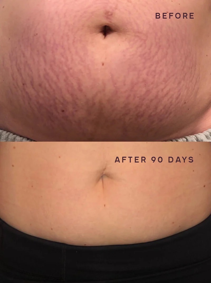 NOUVADerm Treatment 3
