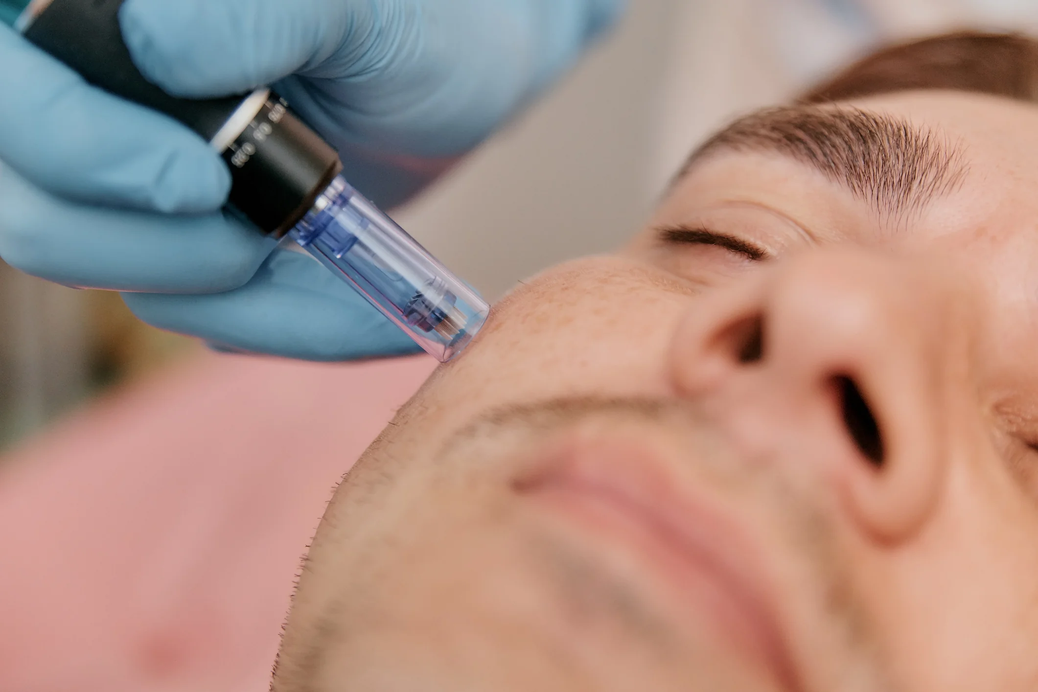 SkinPen® Microneedling