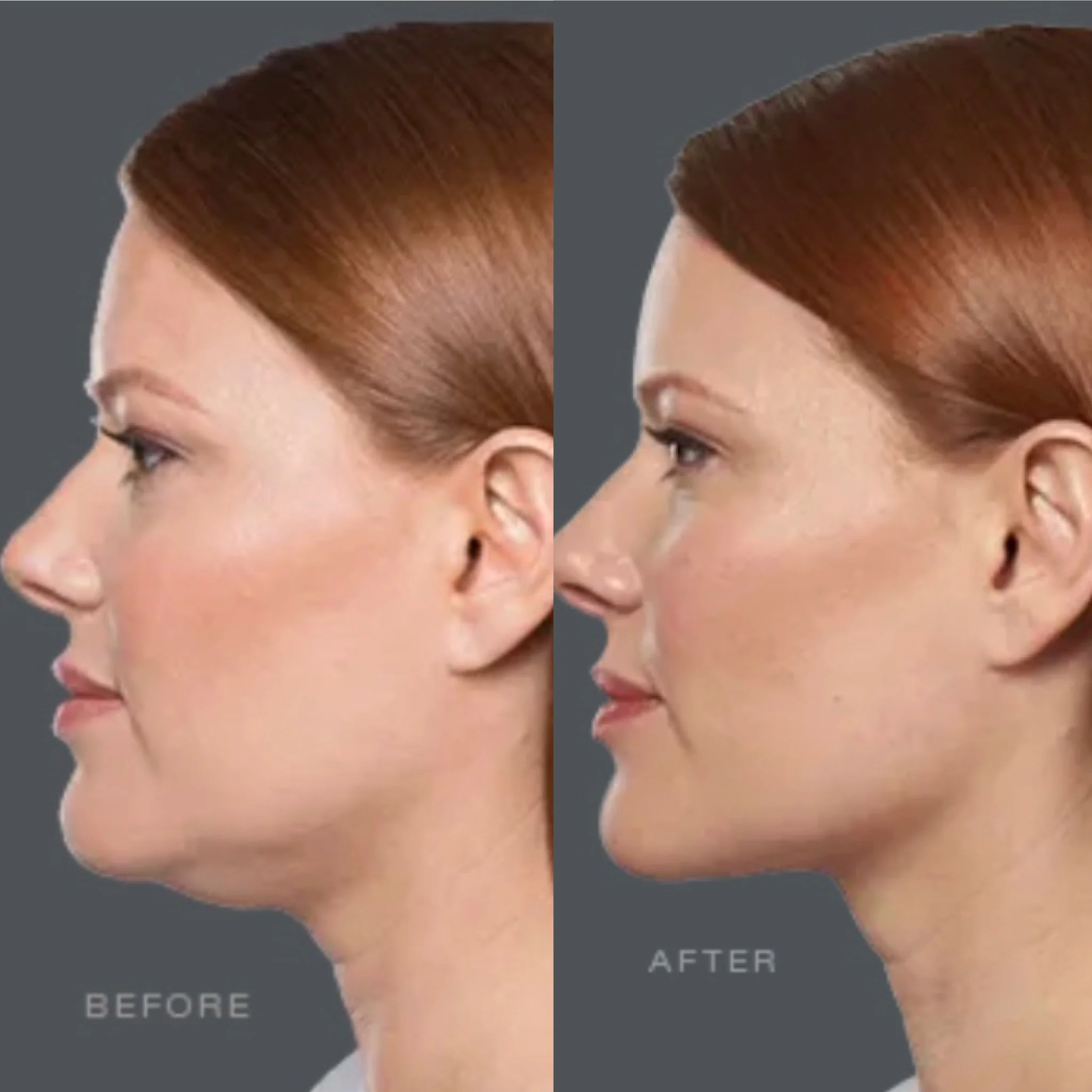 Kybella Before & After