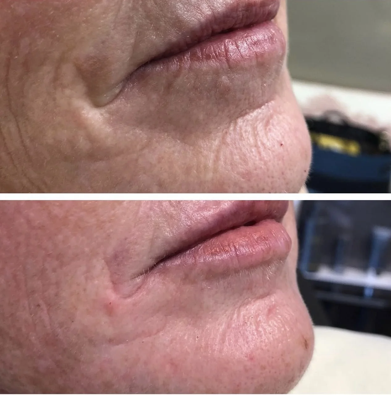 SkinPen Before & After